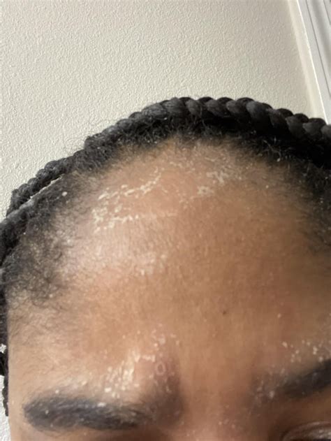 Skin Concerns I Recently Started Having Dry Flaky Skin Spread All