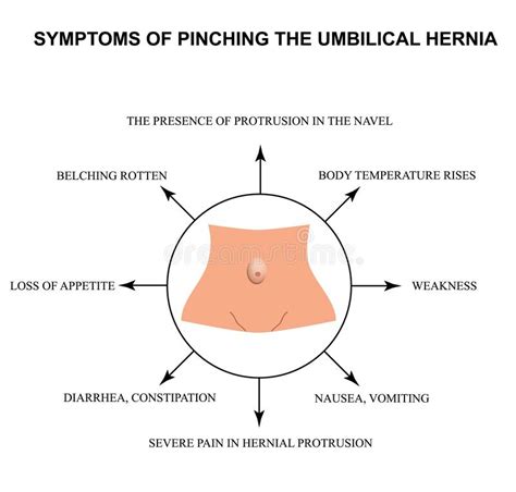 Umbilical Hernia Intestinal Hernia Infographics Vector Illustration