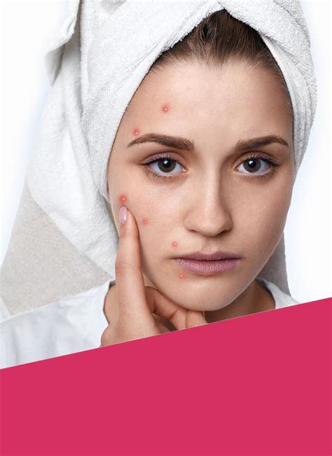 Acne And Blemishes Rewonder Skin Clinic Uk
