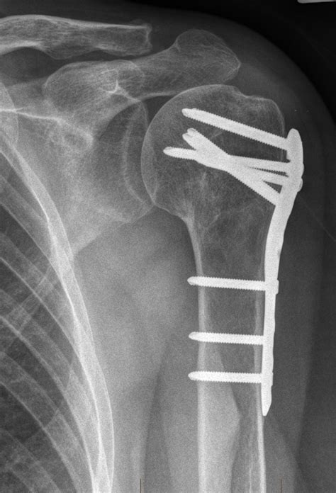 Fractured And Broken Shoulders Orthopaedic Surgeon Adelaide