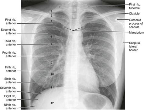 Next, a good inspiration film should show at least the 10th or 11th posterior ribs. Normal Anatomy | Radiology Key