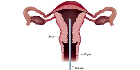 Endometrial Biopsy Everything You Need To Know About The My Xxx Hot Girl