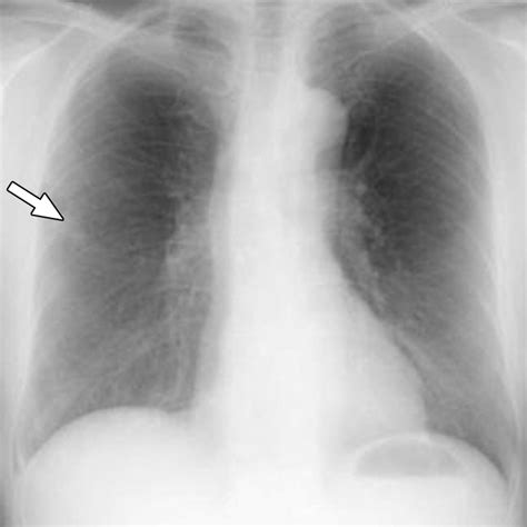 Performance Of Radiologists In Detection Of Small Pulmonary Nodules On