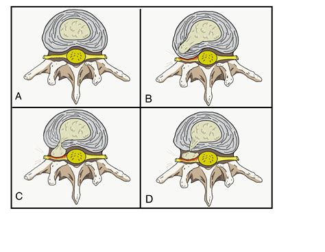 Cervical Disc Herniation Article