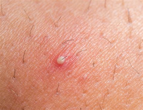 10 Causes And Symptoms Of Folliculitis Facty Health
