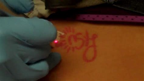 We did not find results for: Laser Tattoo Removal - Pink Ink - YouTube