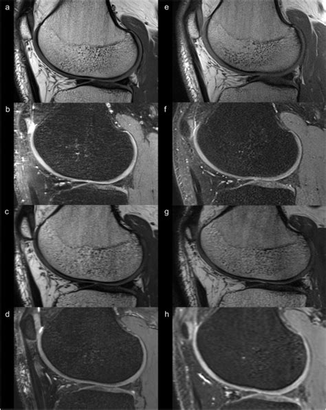Evaluation Of Optimised 3d Turbo Spin Echo And Gradient Echo Mr Pulse
