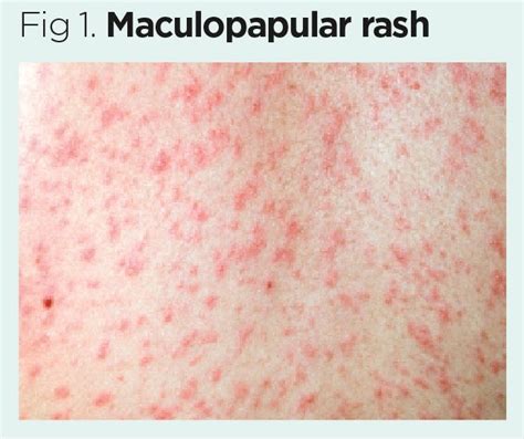 Maculopapular Rash On Face