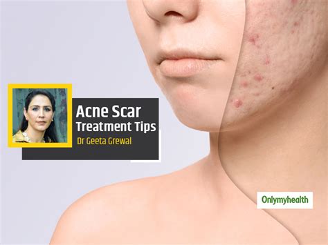 Acne Scars Hiding Your Face Due To Acne Scars Heres How To Get Rid