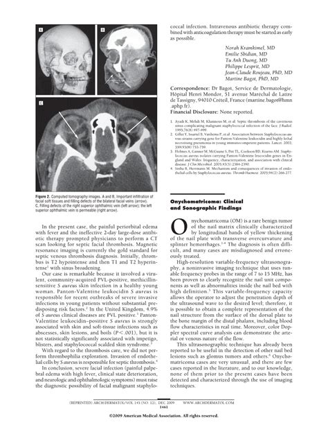 Onychomatricoma Clinical And Sonographic Findings Cardiology Jama