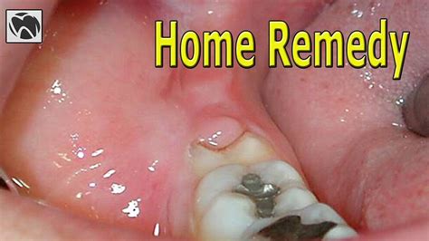 Pericoronitis Home Remedy Best Pericoronitis Treatment At Home