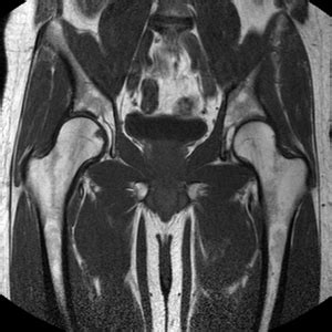 Basic-hip-mri