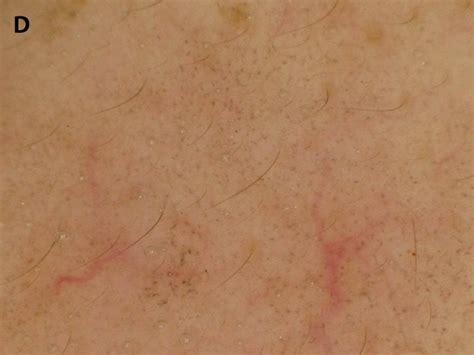 Chronology Of Lichen Planus Like Keratosis Features By Dermoscopy A