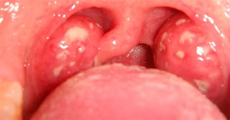 11 Causes Of White Spots On The Throat With Pictures New Health Advisor