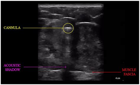 Safety Of Wireless Ultrasound Guided Gluteal Fat Grafting Alan Wong