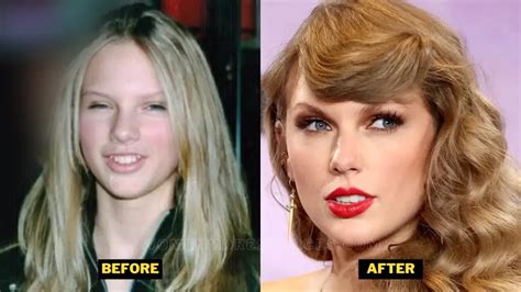 Taylor Swift Smile Transformation Magic Of Dental Veneers