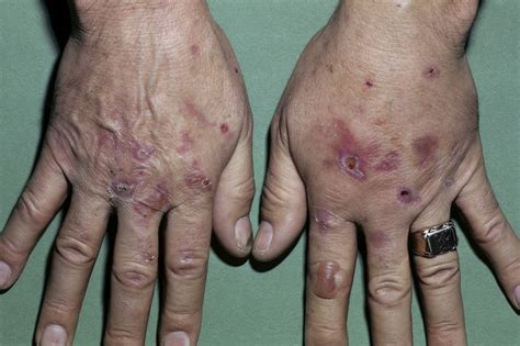 Skin Manifestations Of Chronic Hepatitis C Virus Infection