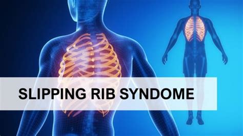 Slipping Rib Syndrome Thoracic Spine Series Centeno Schultz Clinic