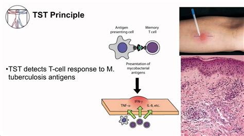 Although the ideal preventive agent, an effective vaccine, is still some time away, several new diagnostic technologies have emerged, and two new tuberculosis drugs have been licensed after almost 50 years of no tuberculosis drugs being. Tuberculosis: Diagnosis - YouTube