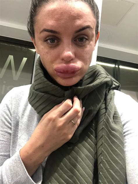 botox gone wrong woman s lips left swollen after getting fillers from ex cons small joys