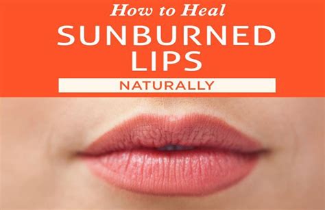 15 Home Remedies To Help You Alleviate Discomfort Caused By Sunburnt Lips