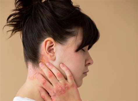 Understanding Seborrheic Dermatitis Ear Causes Symptoms And Treatme