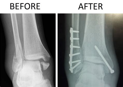 Bimalleolar And Trimalleolar Fractures Ace Physical Therapy And