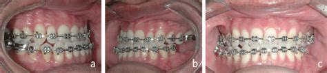Intraoral Pre Operative Images Showing A Class Iii Occlusion A Right