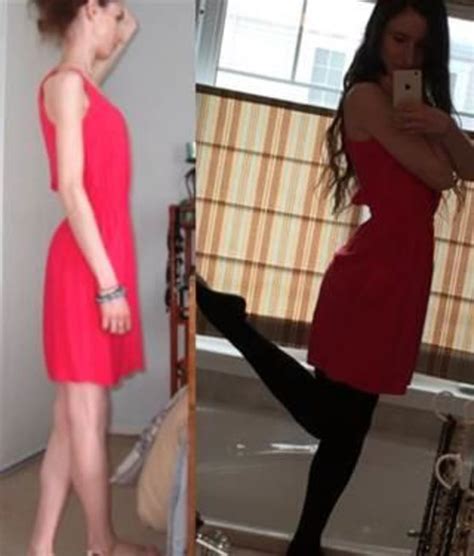 Brave Anorexia Survivor Posts Shocking Recovery Photos On Weight Loss