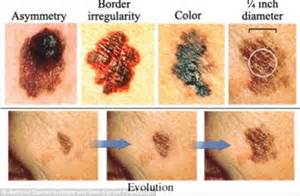 What skin cancer look like. How to tell if YOU have skin cancer from irregular moles ...