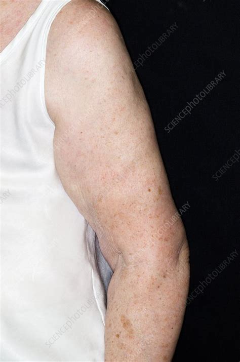 Lymphoedema After Breast Cancer Stock Image C0167372 Science