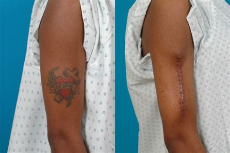 How much will laser tattoo removal cost? Tattoo Removal - VoltaicPlasma - Areton LTD