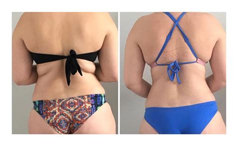 Body Sculpting Weighloss Before And After Results Slimwave Results