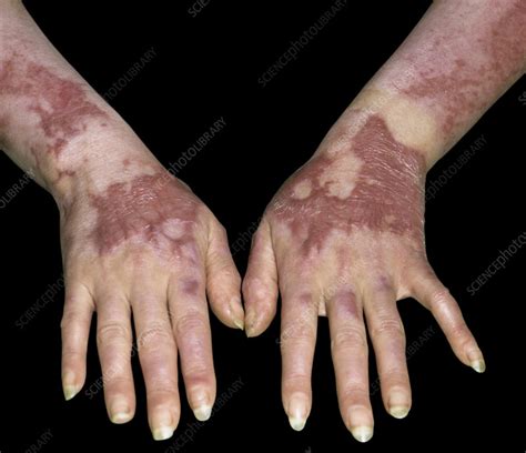 Keloid Scarring In Burn Stock Image C0402275 Science Photo Library