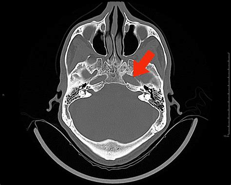 Nasopharyngeal Carcinoma Presenting As Third Nerve Palsy Consultant360