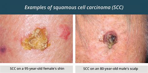 How Do You Know If A Skin Cancer Has Spread Skin Cancer Image Gallery