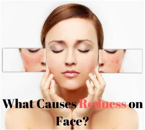 Redness On Face 6 Common Causes With Home Remedies Redness On Face