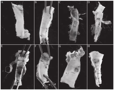 Morphological Observation Of The Carotid Artery With The Naked Eye A