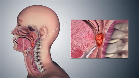 They're named for the specific part of your head or neck they affect. Throat cancer: Symptoms, pictures, causes, and treatment