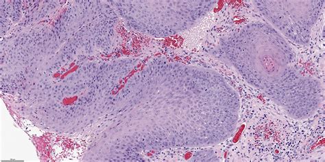 Pathology Outlines Papilloma
