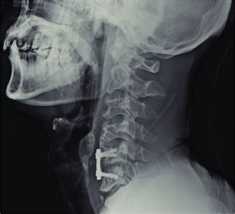 Lateral Radiograph Of The Cervical Spine Demonstrates Satisfactory