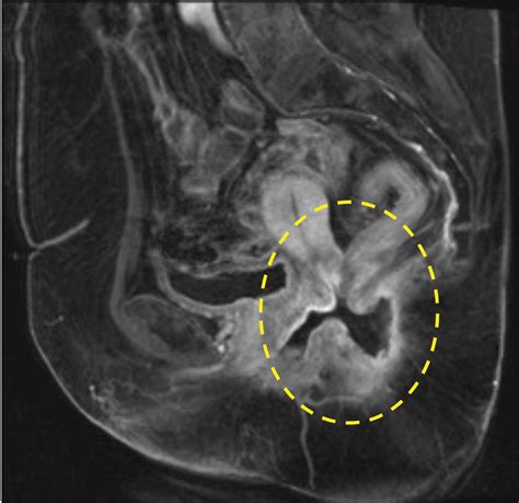 Imaging And Surgical Management Of Anorectal Vaginal Fistulas