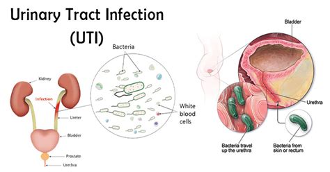 Urinary Tract Infection Uti Mahaba Herbal Limited