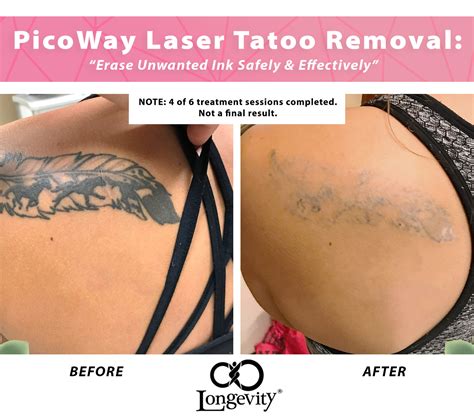 Discover Tattoo Removal First Session Latest In Eteachers