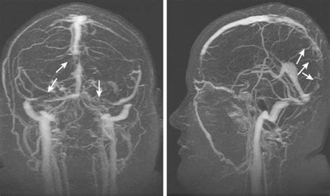 Cerebral Venous Thrombosis Radiology Key