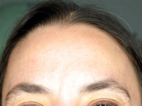 before and afterbotox — cpw vein and aesthetic center
