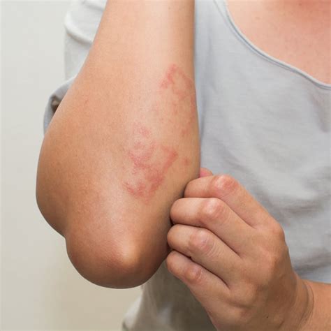 New In Covid 19 Skin Rashes Linked To Virus Apex Dermatology And Skin