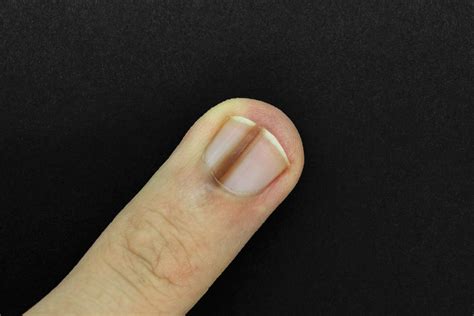 Linear Pigmentation Nails Best Nail Designs 2020
