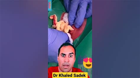 Massive Cyst Drainage Shorts Dr Khaled Sadek Youtube