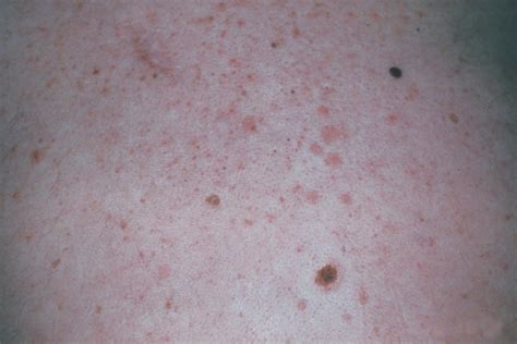 Light Colored Dry Spots On Skin